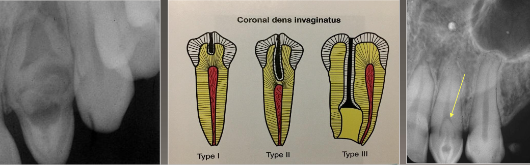 <ul><li><p>Deep surface enamel invagination of the crown or root “ tooth within tooth”</p></li><li><p>Can be coronal (most frequent) or radicular</p><ul><li><p><strong>Type I: </strong>Invagination is confined to the crown</p></li><li><p><strong>Type II: </strong>Invagination extends below the CEJ</p></li><li><p><strong>Type III: </strong>Invagination may extend through the root</p></li></ul></li></ul><p></p>