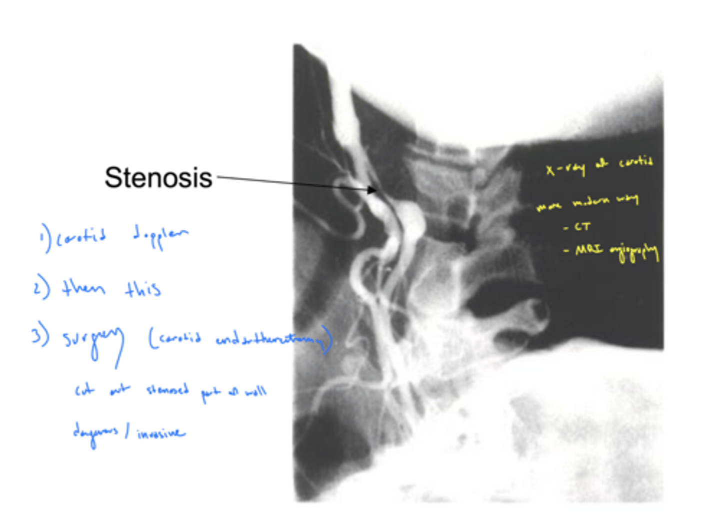 <p>stethoscope (carotid bruit) → blood flow creates friction as move across materials deposited in vessel walls</p><p>listen for turbulent blood flow (have patient hold their breath)</p>