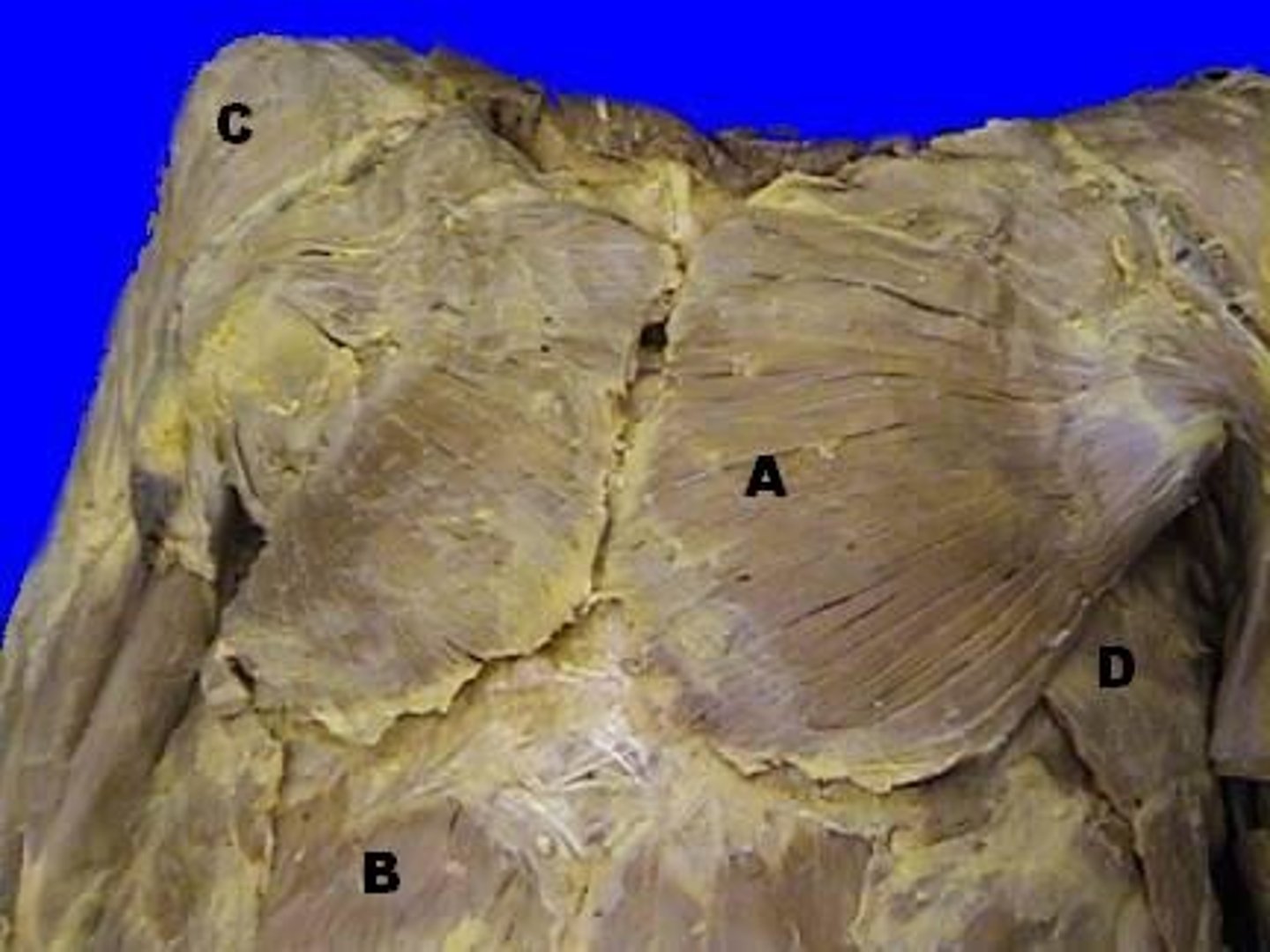<p>A-, All fibers: adduct the shoulder (glenohumeral joint), medially rotate the shoulder, assist in elevating the thorax in forces inhalation</p>