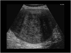 <ul><li><p><span>BENIGN Small, solid, hypoechoic tumor</span><br><span>ASSOCIATED W/ MIEG'S</span><br><span>No internal cystic structures</span><br><span>(u) No calcifications, but possible</span><br><br><span>*Very similar to granulosa cell tumor</span></p></li></ul><p></p>