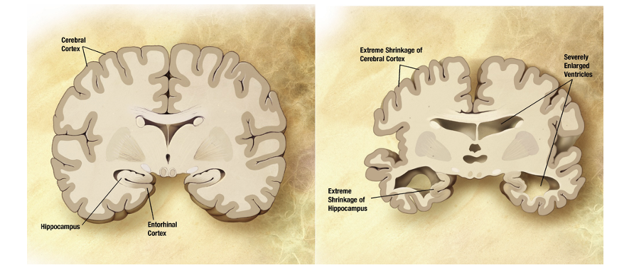 <ul><li><p>degrades the ability to form and retain recent long-term memories</p></li><li><p>involves the degeneration of cells in the hippocampus, and pathology spreads to MTL &amp; affects cortex</p></li><li><p>initial pathology is localized in the hippocampus, which is why primary deficit is the inability to form long-term memory</p></li></ul><p></p>