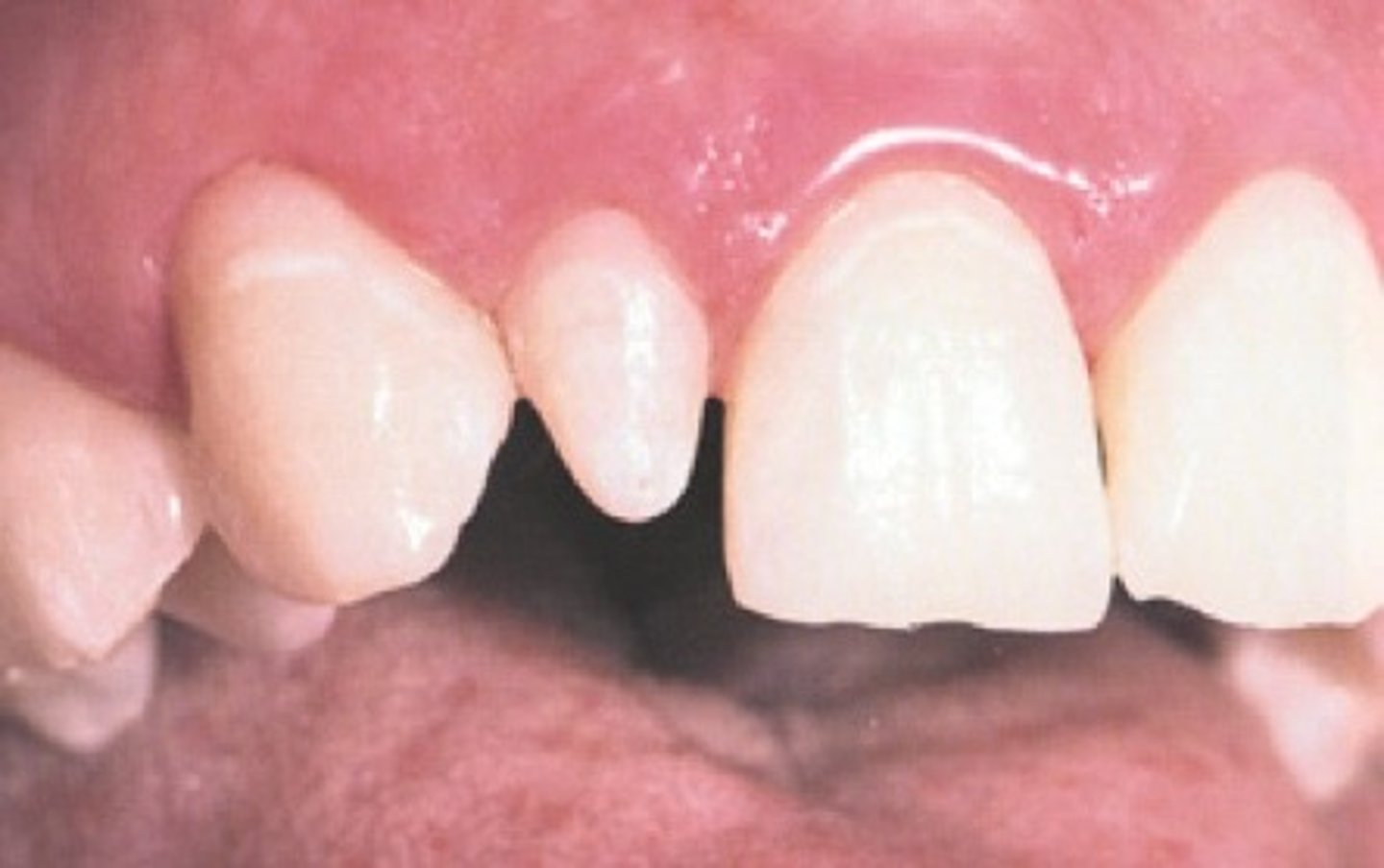 <p>Small teeth. "Peg Lateral"- Maxillary lateral incisor-most common</p>