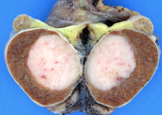 <ul><li><p>Account for ~45% of testicular cancers</p></li><li><p class="p1">Malignant tumour <strong>derived from seminiferous epithelium</strong> that retains characteristics of <strong>primary spermatogonia</strong></p><ul><li><p class="p2">Neoplasm generally consists of a single cell type</p></li></ul></li><li><p class="p1">Slow growth and lymphatic spread</p><ul><li><p class="p3">Mostly limited to testicle or retroperitoneal nodes</p></li></ul></li><li><p class="p1">Good prognosis due to radio-sensitivity</p></li></ul><p></p>