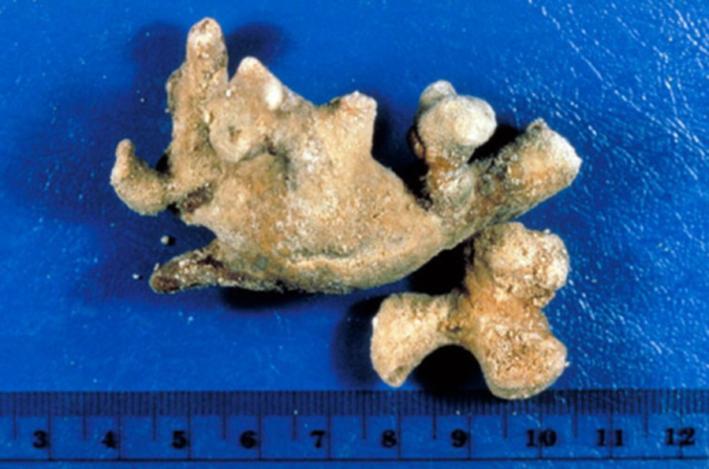 <p>struvite stone that extends to full the renal pelvis</p>