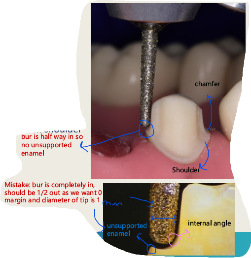 <ul><li><p>Tapered and rounded at the end, with 1 mm diameter so hold the bur tip half way in to not create a curve which results in unsupported enamel </p></li><li><p>90 degrees</p></li><li><p>Rounded internal angle</p></li><li><p>Avg - 0.5 mm (0.3-0.7mm)</p></li></ul><p></p>