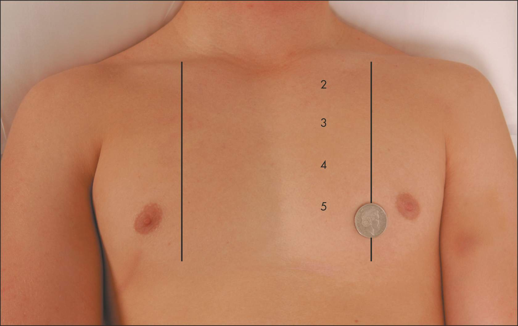<ol><li><p>Apex of the heart&nbsp;(coin)</p><ul><li><p>in a thin person</p></li><li><p>in cardiac conditions that cause a forceful apex beat</p></li></ul></li><li><p>A right ventricular impulse may be seen in the 3rd, 4th or 5th intercostal spaces at the left sternal edge</p><ul><li><p>in right ventricular hypertrophy</p></li></ul></li><li><p>Over the pulmonary artery at the left 2nd intercostal space</p><ul><li><p>if severe pulmonary hypertension is present</p></li></ul></li></ol><p></p>