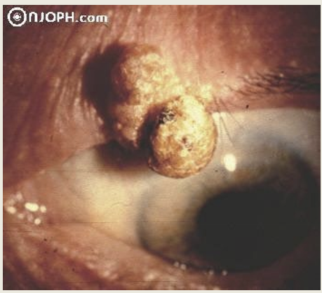 <p>2x more likely to be Premalignant or malignant </p>