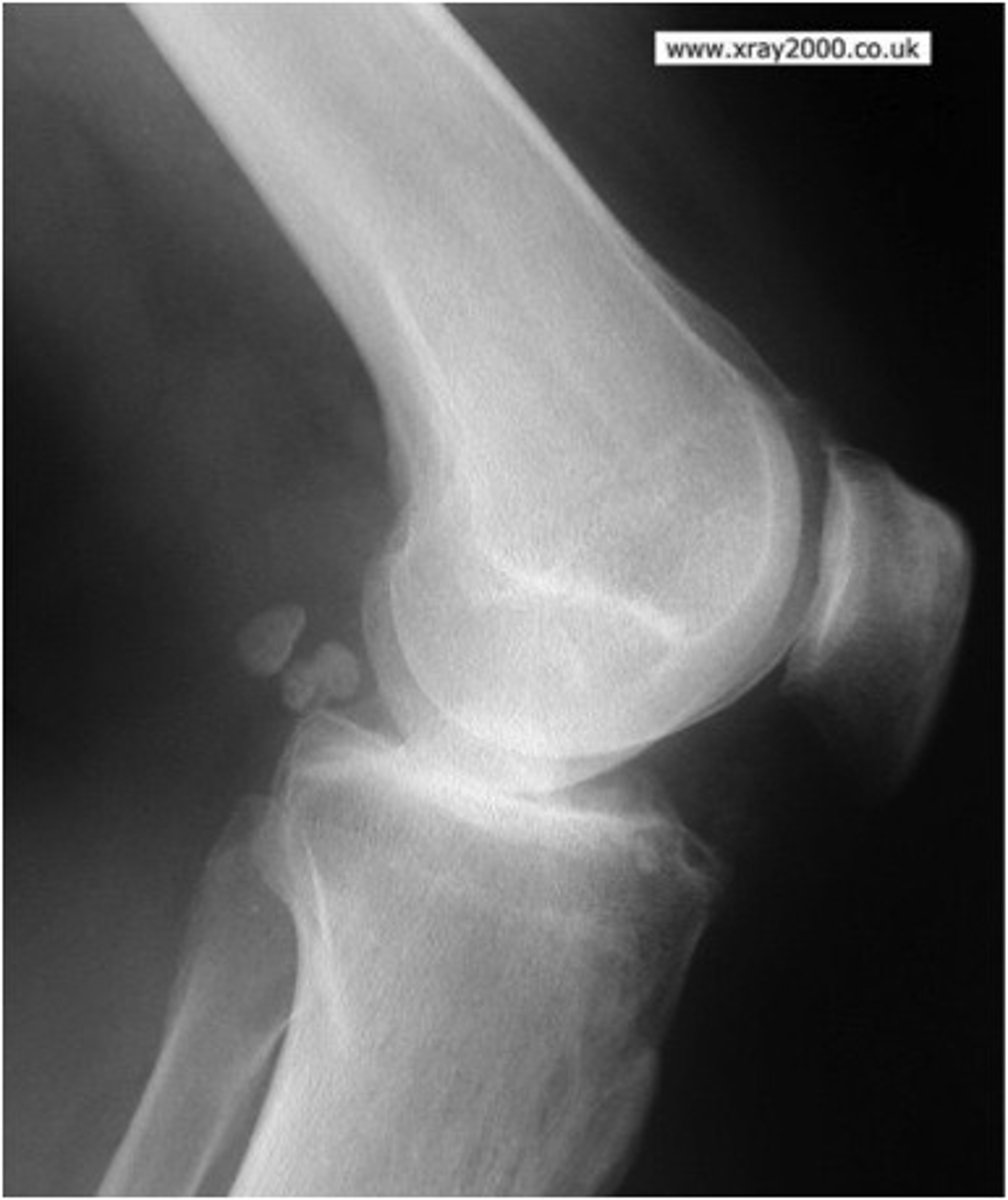 <p>Is this a fracture?</p>
