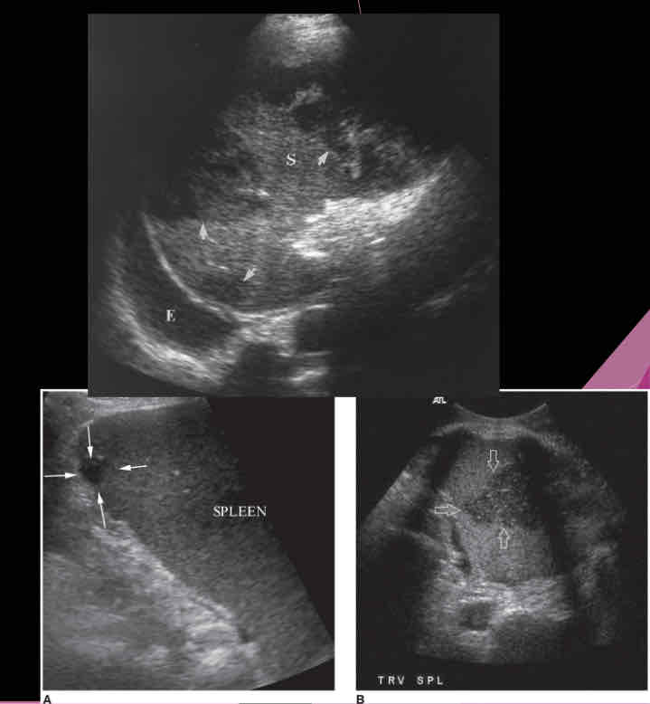 <p>What does the following describe?</p><p>•Areas of tissue death, blood supply is cut off</p><p style="text-align: start">•Found in patients with leukemia, sickle cell anemia, pancreatitis, bacterial endocarditis</p><p style="text-align: start">•Calcification is last change</p>