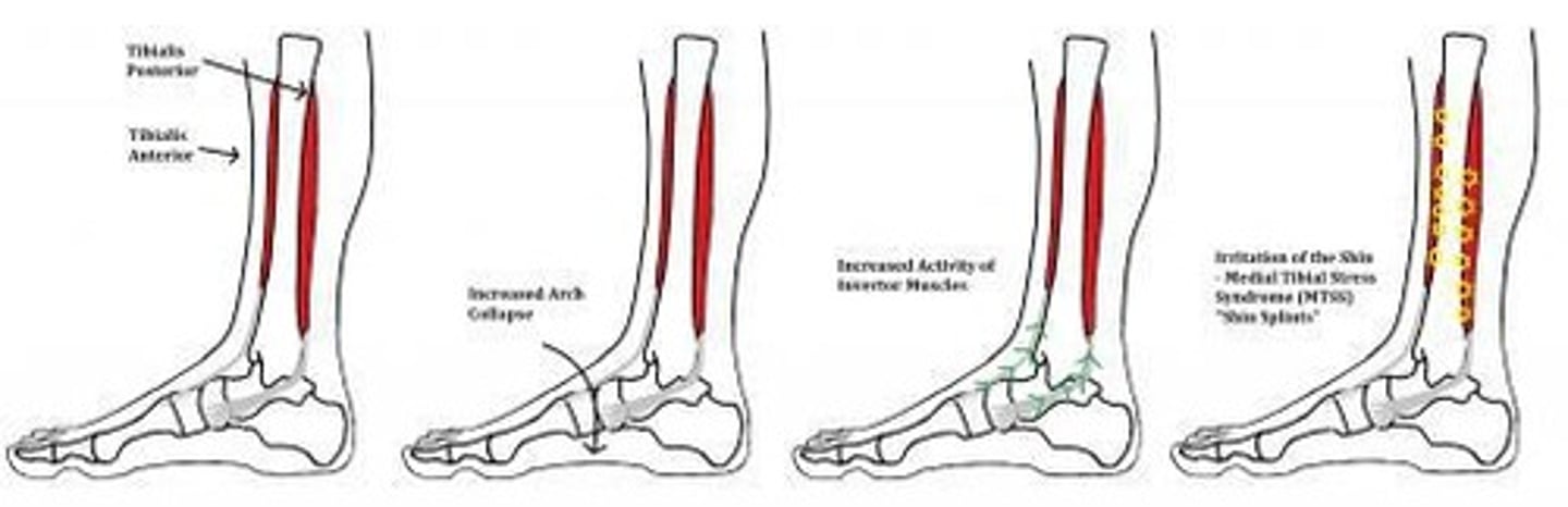 <p>Medial Tibial Stress Syndrome (MTSS) is often a result of muscular imbalance.</p>