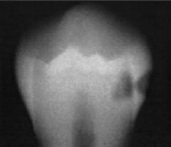 <p>classify this according to radiographic presentation of the ADA </p>