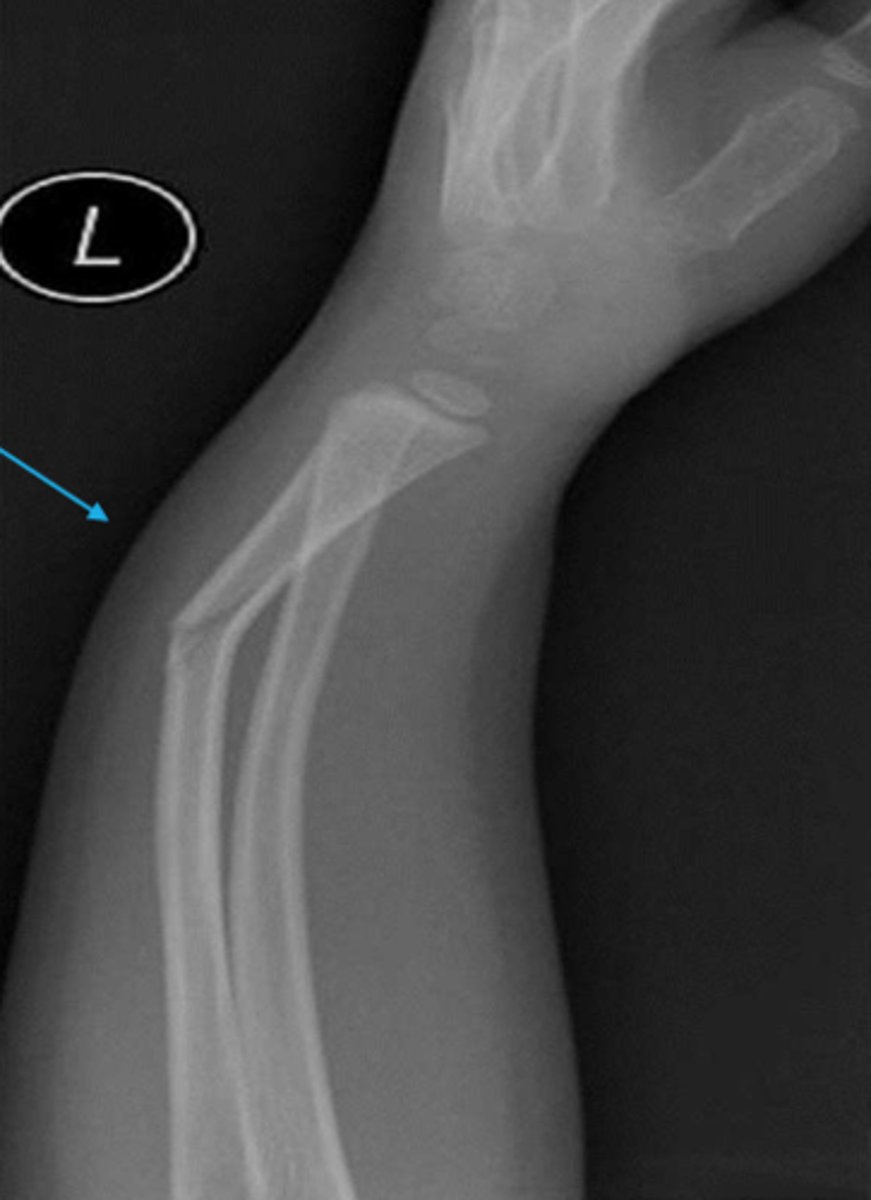 <p>What type of fracture is this?</p>