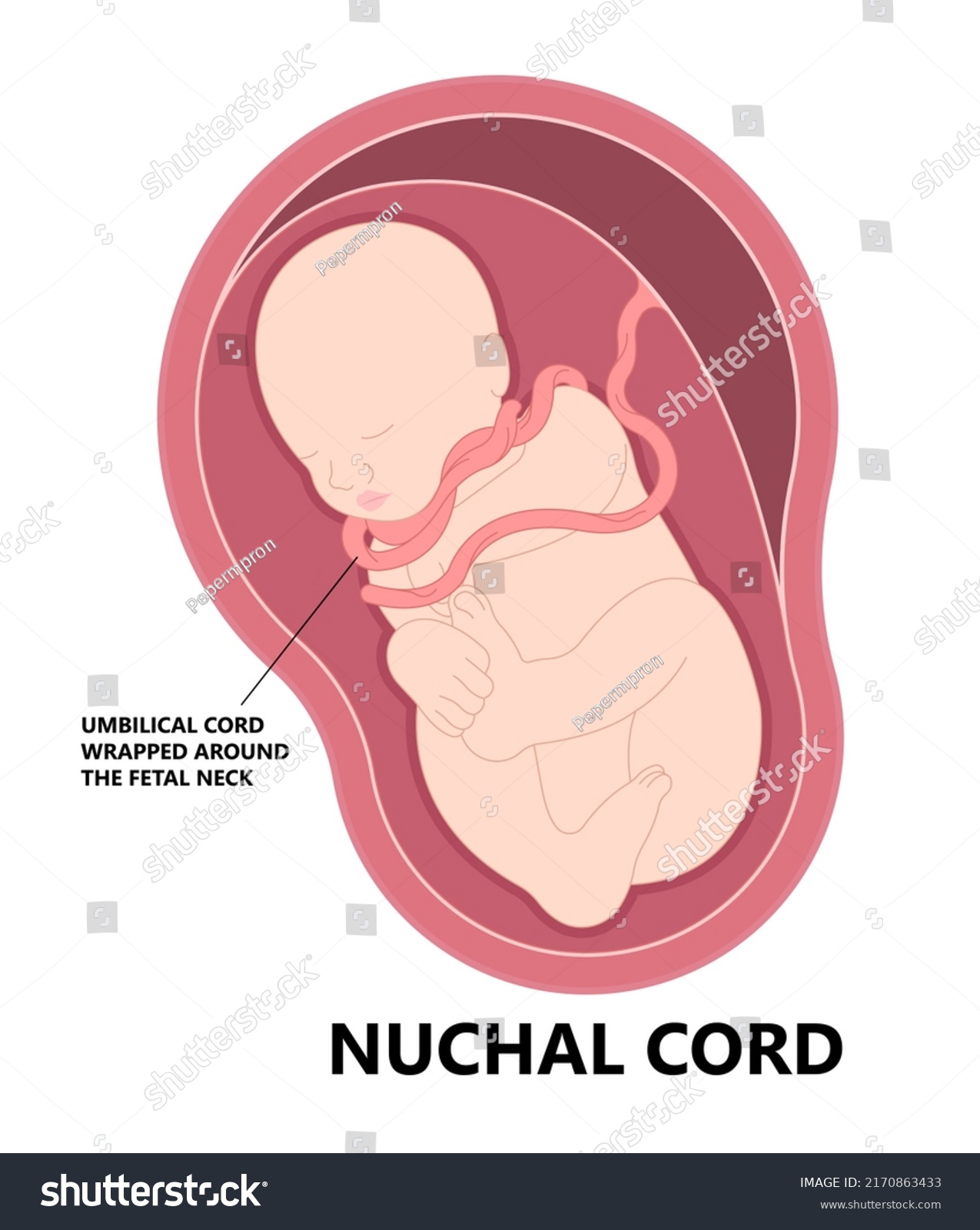 <p>Nuchal Cord</p>