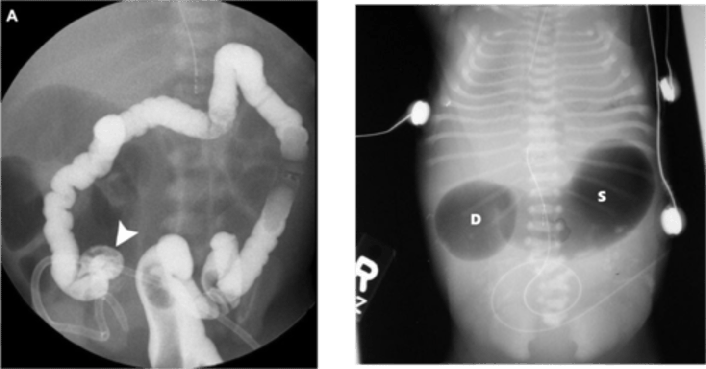 <p>Define Condition:</p><p>Congenital discontinuity occurring in SI (segment of SI is absent/so narrow that nothing can pass through)</p><p>-Hx: Prenatal or First 2 days of life</p><p>-Path:</p><p>&gt; 60% = Duodenum</p><p>&gt;&gt; D/t failure of GI tract to "recanalize" (open up) during embryologic development during 8-10 weeks of gestation</p><p>&gt; 20% = Jejunum/Ileum</p><p>&gt;&gt; D/t interruption of SI's vascular supply during fetal life (something preventing blood from fetus' distal SI)</p><p>-Sx/PE: If not seen on US</p><p>&gt; BILIOUS EMESIS (obstruction DISTAL to Ampulla of Vater)</p><p>&gt; Abdominal Distension</p><p>&gt; Inability to pass meconium</p><p>-Dx:</p><p>&gt; Routine Prenatal US (May also see Polyhydramnios b/c can't swallow amniotic fluid)</p><p>&gt; CXR</p><p>&gt;&gt; Duodenum = Double Bubble Sign (distension of two anatomic locations proximal to obstruction = stomach &amp; proximal duodenum)</p><p>&gt;&gt; Jejunal/Ileal = Dilated loops of small bowel with air-fluid levels</p><p>&gt; Contrast Radiography/Fluoroscopy</p><p>&gt;&gt; Contrast will cease to flow once it reaches the site</p><p>-Tx: SURGERY</p><p>&gt; Take two healthy ends of tract and connect them to each other (Duodeno-duodennostomy = duodenum connect to another portion of duodenum)</p>