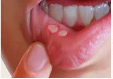 <p>painful, small, round ulcerations with yellow-gray centers surrounded by red halos found on buccal and/or labial mucosa </p><p>-unknown etiology, thought to be an immune mechanism</p>