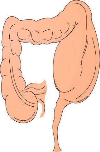 intussusception