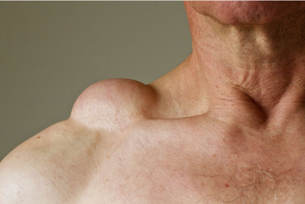 <p>Lipoma</p>