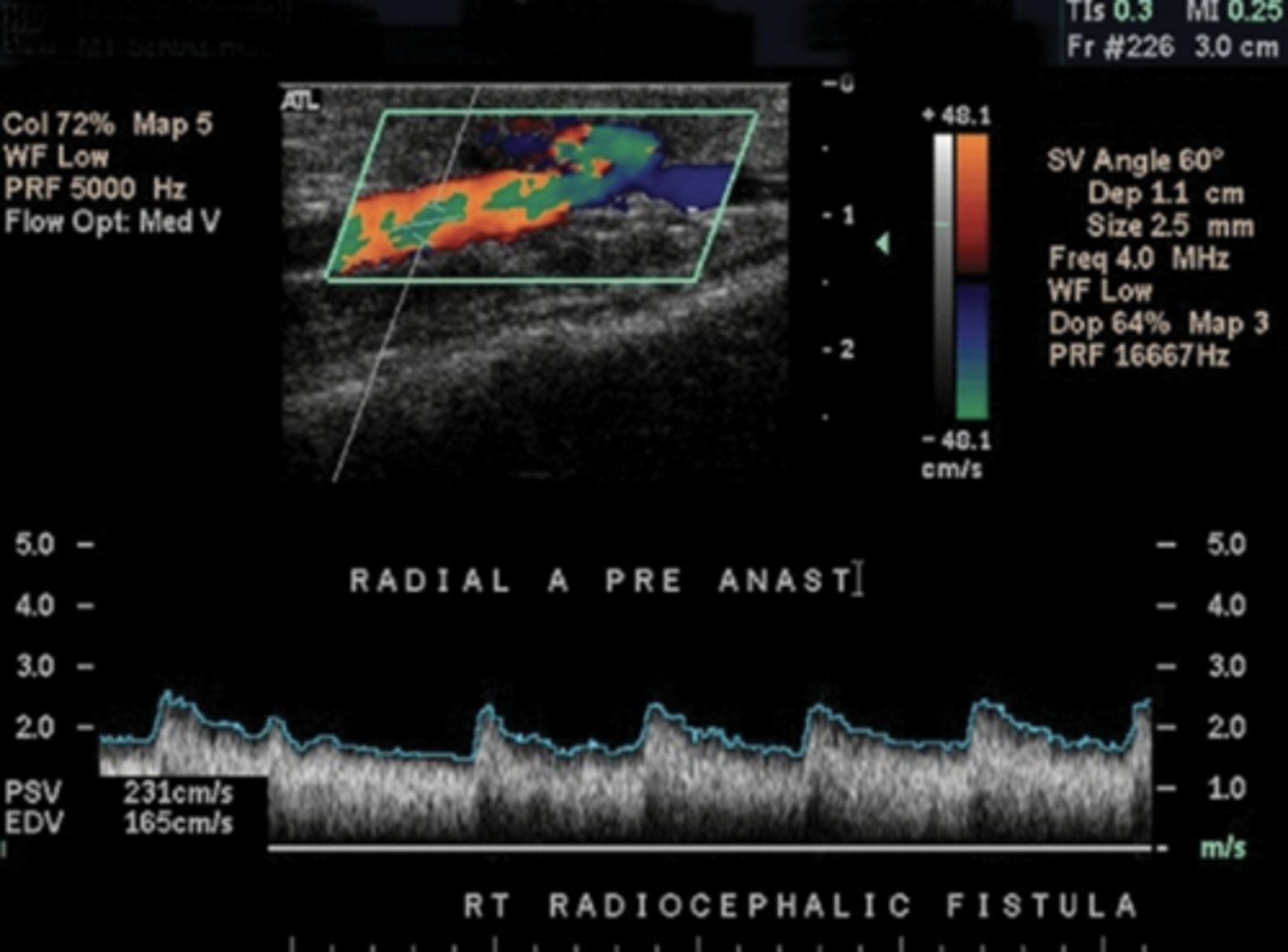 <p>Proximal to anastomosis</p><p>Low resistant - forward diastolic flow &amp; spectral broadening</p>