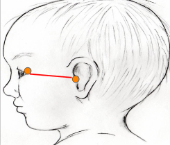 <ul><li><p>Tragion </p></li><li><p>Excanthion - point just lateral to the eye </p></li><li><p>length of right tragion to excanthion </p></li><li><p>length of left tragion to excanthion </p></li><li><p>difference between right and left </p></li><li><p>measure orbit depth asymmetry </p></li></ul><p>Tool - Facial Caliper or Tape Measure</p>