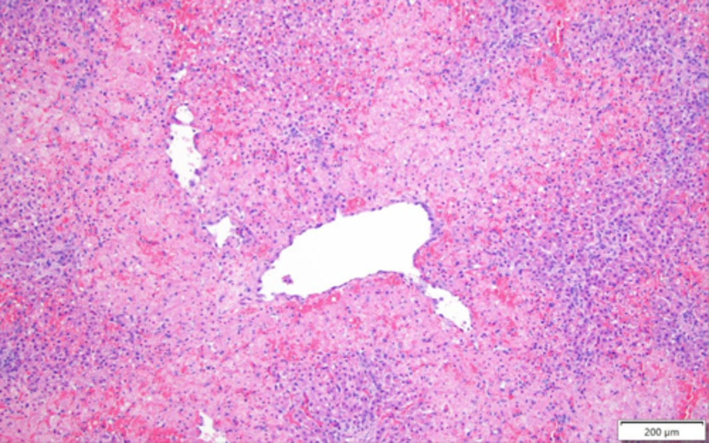 <p>Distention of central vein and sinusoids, progression to hepatic steatosis to atrophy to centrilobular necrosis with hemorrhage</p>