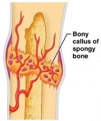 forms as a bulging deposit around the area of the break as a bone heals. Replaces procallus. complete by 6-8 weeks
