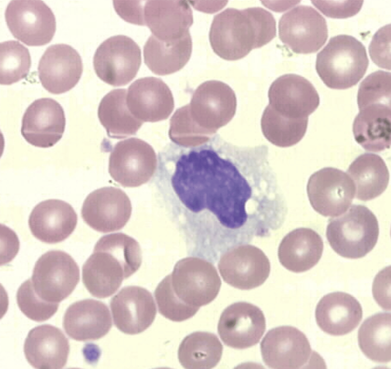 <p>&gt; nucleus: large ; may be kidney shaped, folded, or round ; "brain-like" convolutions, lacy or delicate chromatin</p><p>&gt; cytoplasm: dull gray-blue on Wright's stain ; "ground glass" appearance ; may have vacuoles ; may have blunt pseudopod projections</p><p>&gt; N:C ratio -- 2:1 or 1:1 (abundant cytoplasm</p>