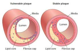 <p>U<strong>nstable plaques are lipid-rich and have a thin fibrous cap, </strong>while<strong> stable plaques contain fewer lipids and have a thicker fibrous capsule.</strong></p>