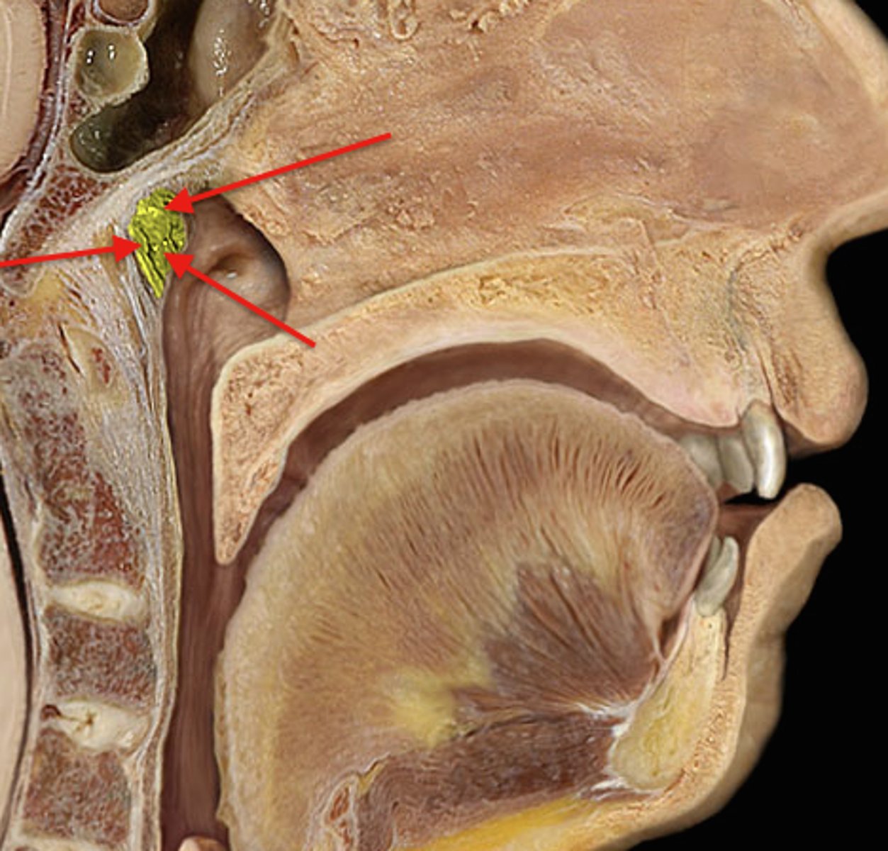 <p>Location: Superior, posterior wall of the nasopharynx</p><p>Description: Known as adenoids when infected or inflamed</p>