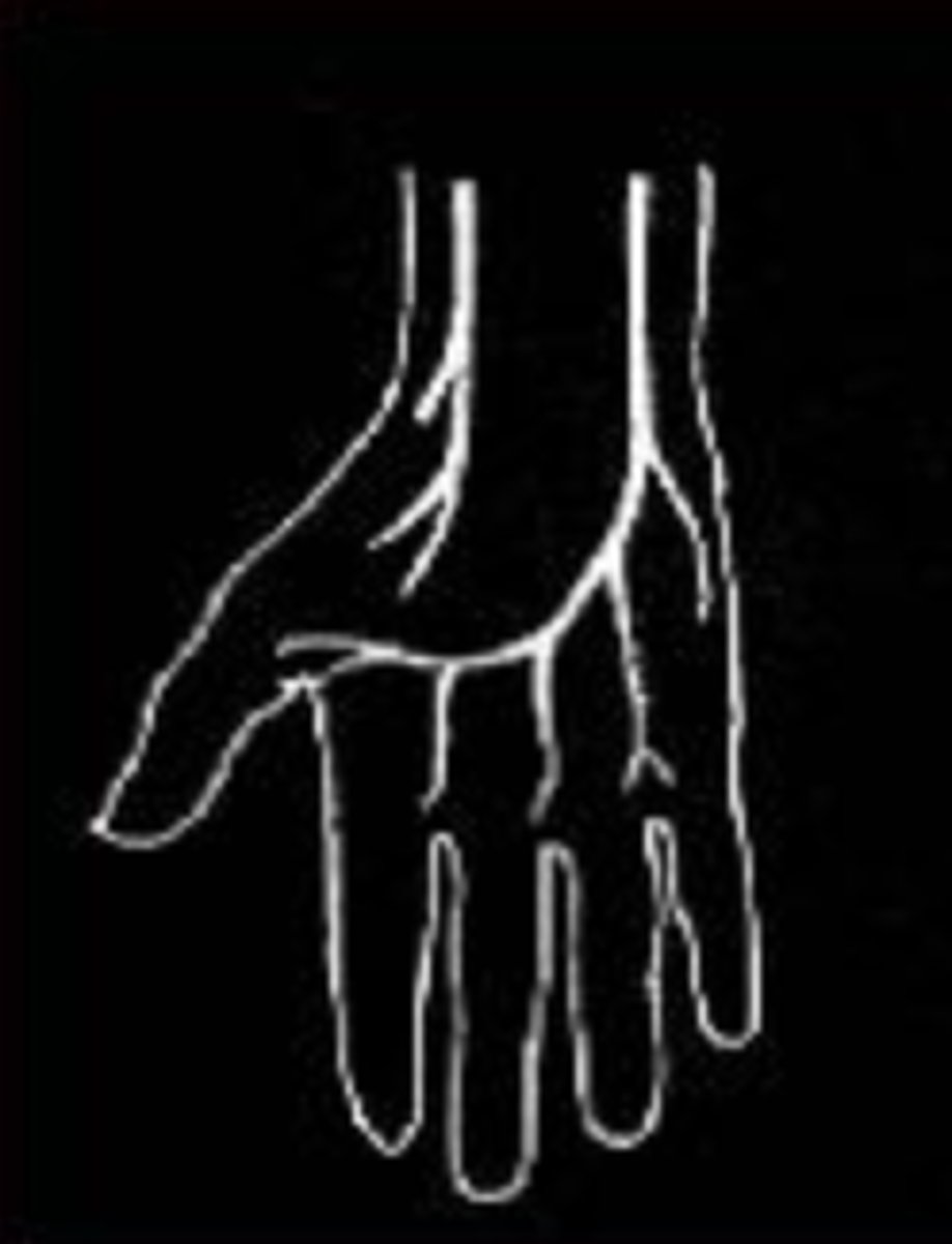 <p>ulnar dominant</p>