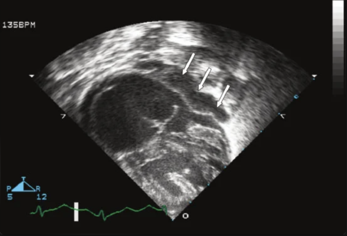 <p>3 week old F presents to doc with respiratory distress and oxygen saturation in the 80s. Subcostal picture shows…</p>