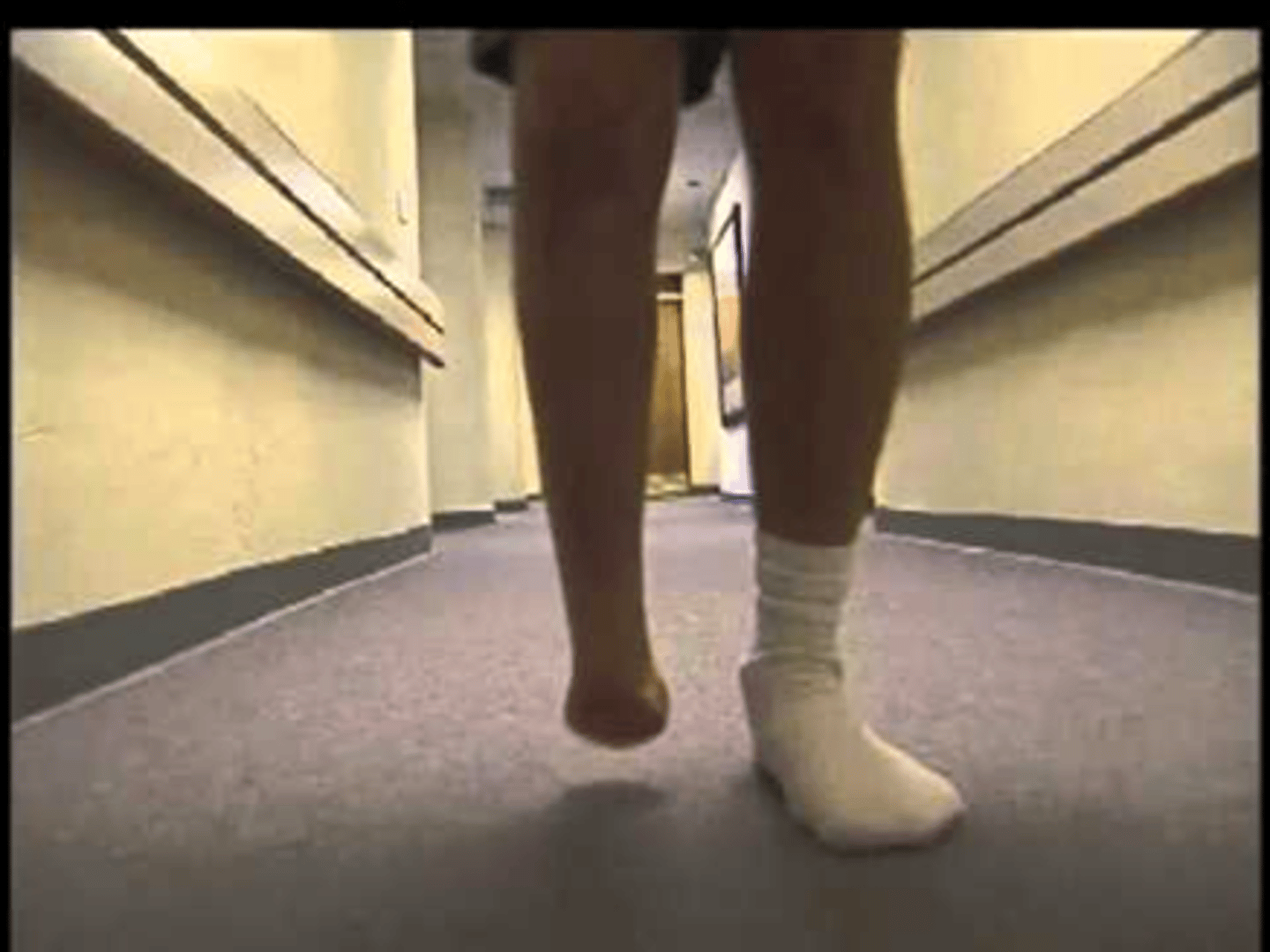 <p>Ankle (symes) disarticulation</p>