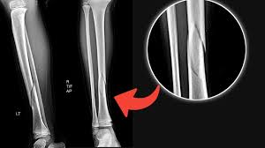 <p>What plane is this fracture in? </p>