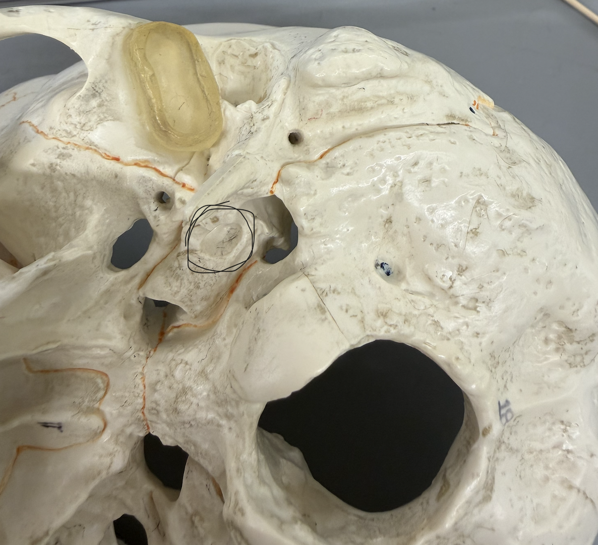 <p>large, deep opening on inferior side of petrous portion of bone; passes through petrous portion; passageway for carotid artery</p>