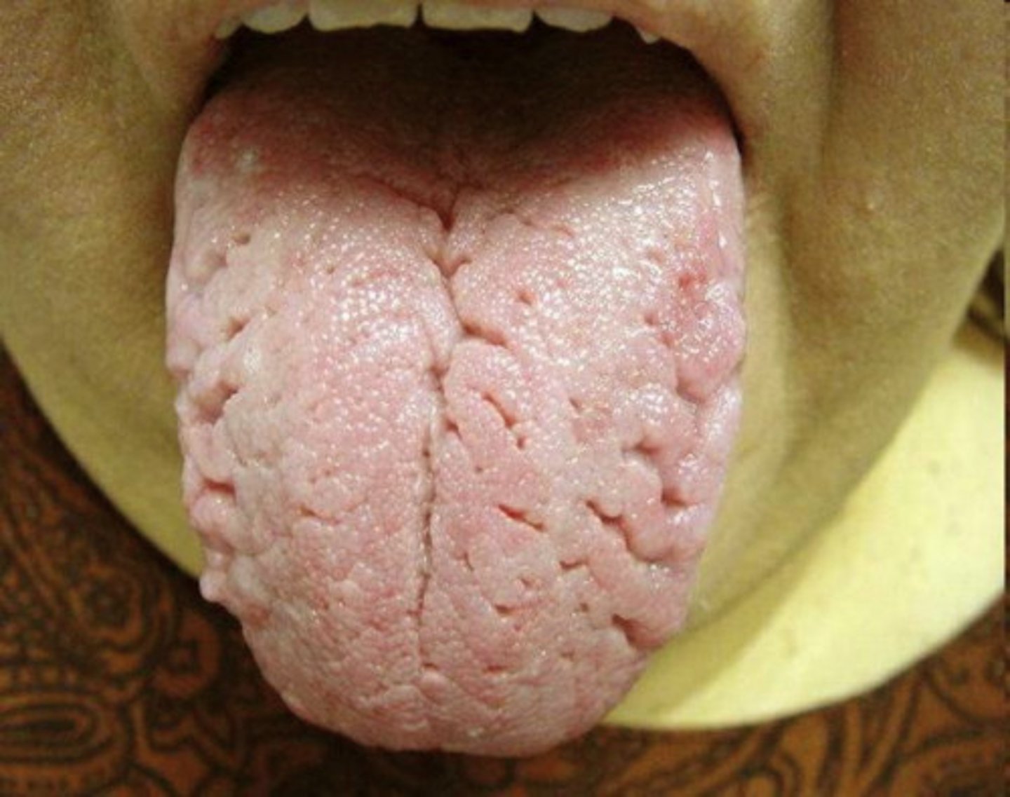 <p>cracks in tongue</p><p>> more common in older individuals, those with xerostomia</p>