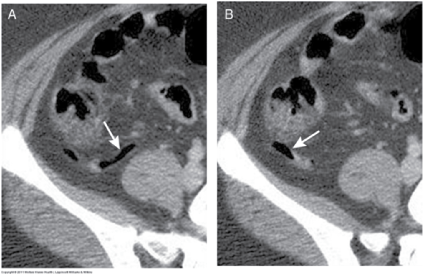 <p>can be seen where it joins cecum, often not seen on CT</p>