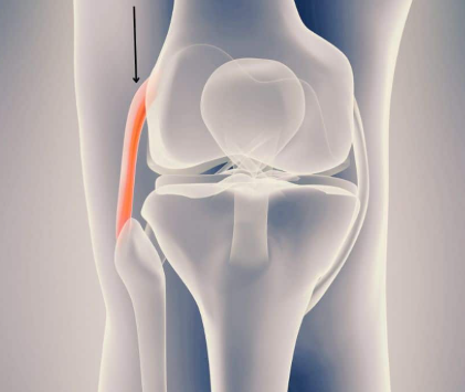 <p>A ligament in the knee that provides stability by connecting the femur to the fibula on the outer side of the knee. </p>