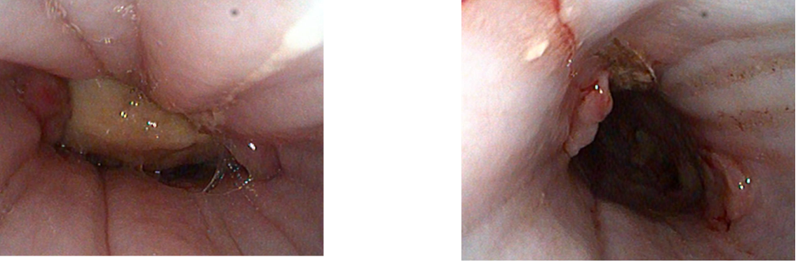 <p>treat for esophagitis, consider placement of esophagostomy tube</p>