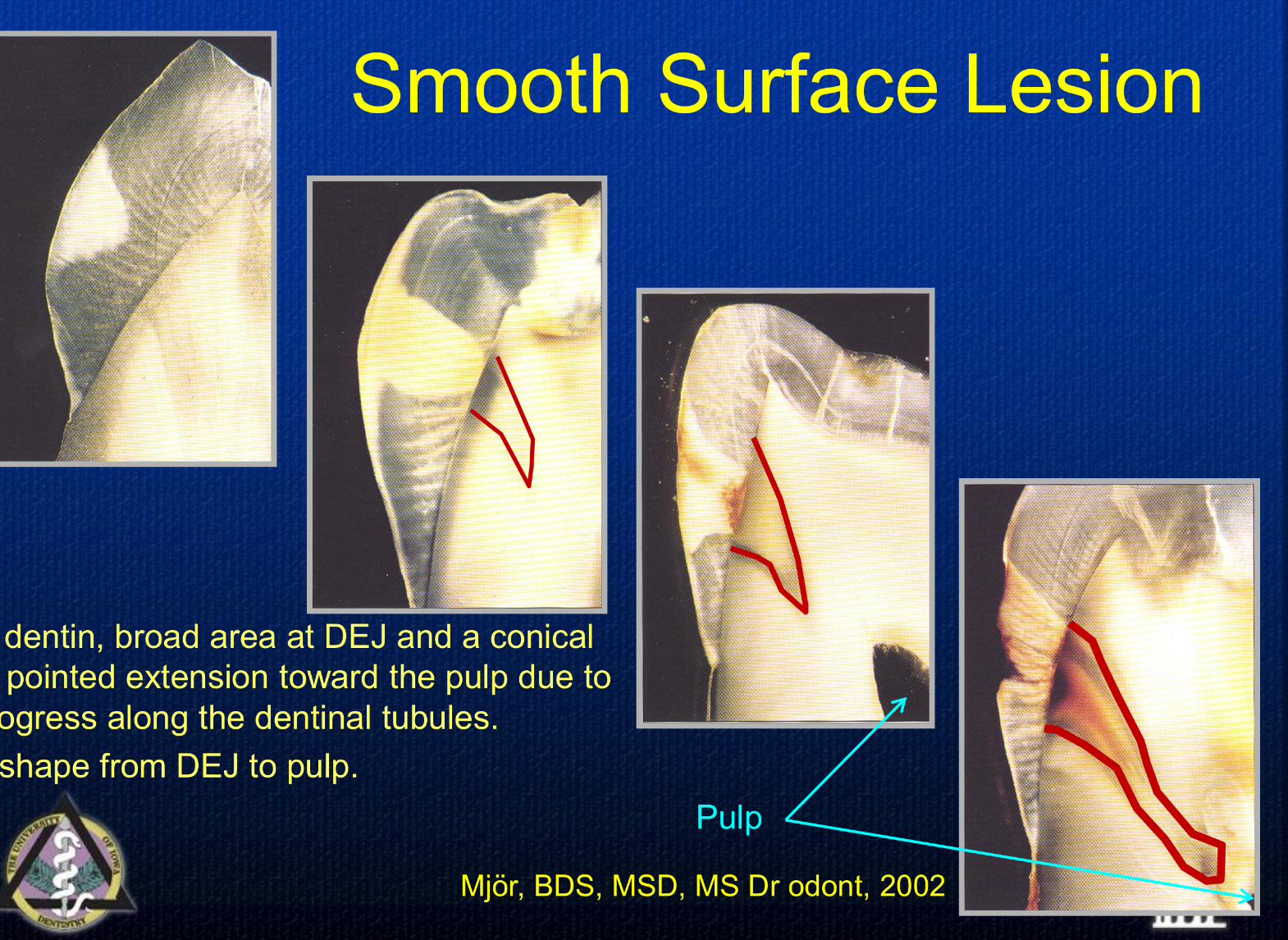 <p>progresses from the surface towards the DEJ due to progression along enamel rods in a V shape</p>
