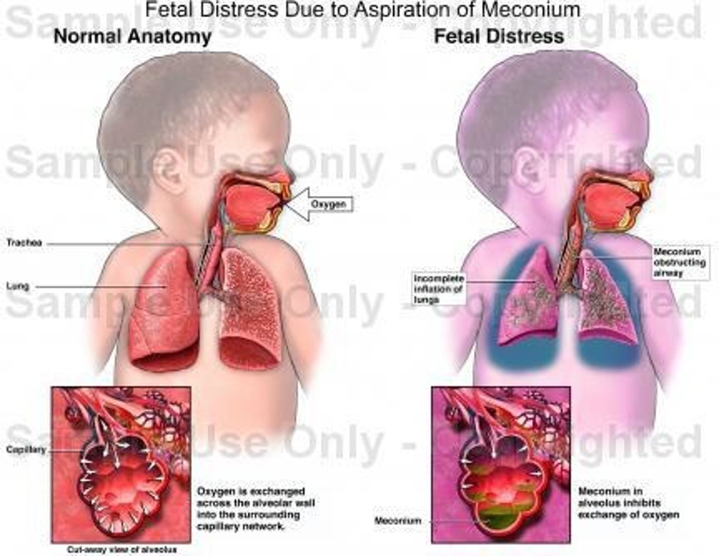 <p>A condition occurring in newborns exposed to meconium, leading to respiratory distress.</p>