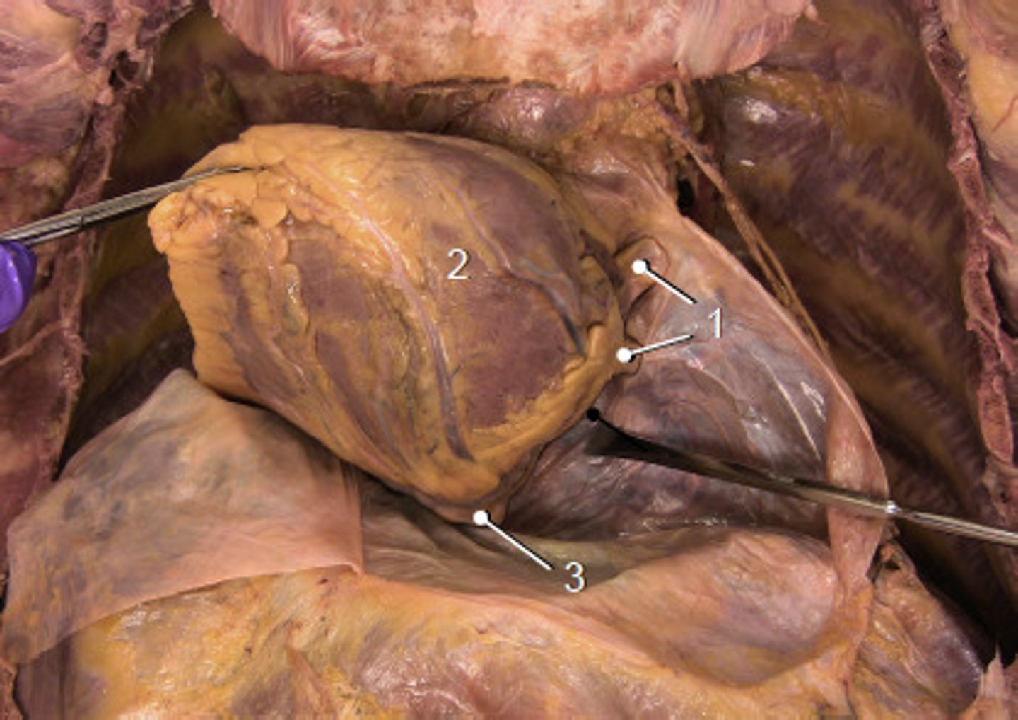 <p>blind recess on posterior aspect of heart caused by pericardial reflections off the pulmonary veins and inferior vena cava</p>