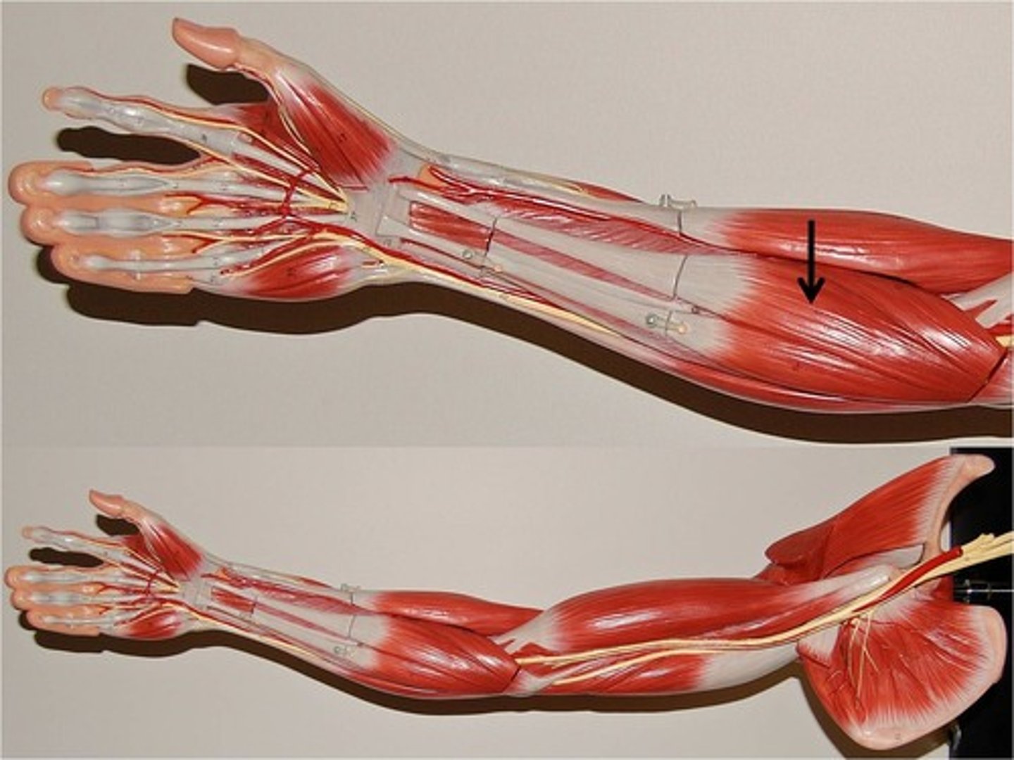<p>origin: medial epicondyle of humerus<br>insertion: bases of second and third metacarpal bones<br>action: flexion and abduction at wrist</p>