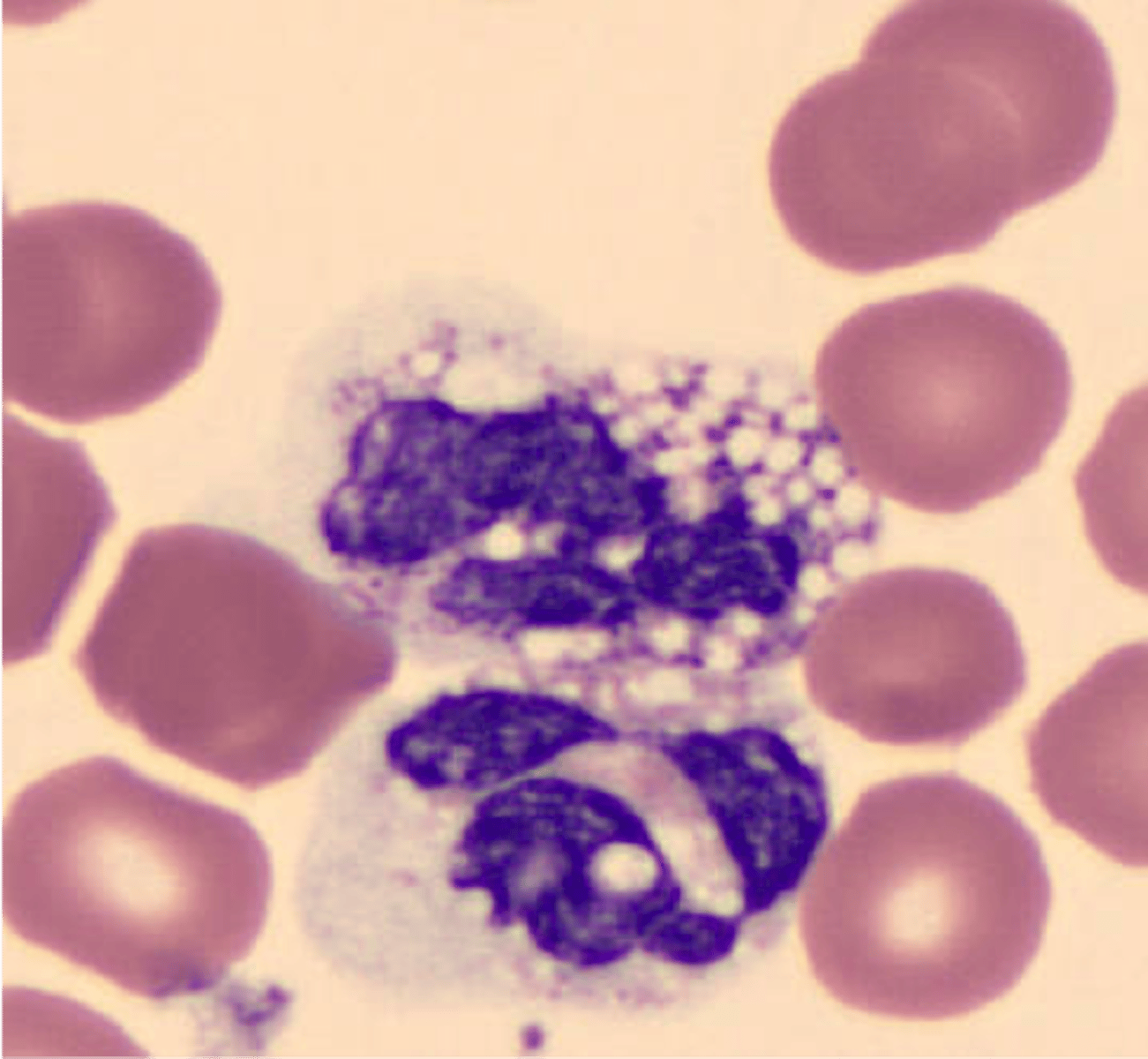 <p>- Unstained circular area within cytoplasm</p><p>- Associated with bacterial or fungal infections when seen with neutrophils</p>