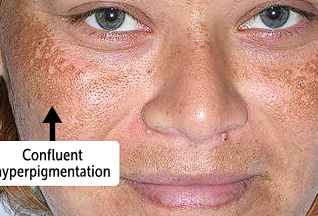 <p><span>benign disorder of hyperpigmentation that results in brown or tan macules and patches, primarily on the face.</span></p><ul><li><p>major concern is cosmetic disfigurement </p></li></ul><p></p>