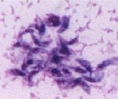 <p><strong>1. Identify the parasite (Genus, species, and stage).</strong><br>→ <em>Toxoplasma gondii</em> trophozoite</p><div data-type="horizontalRule"><hr></div><p><strong>2. Mention the resting form of this parasite.</strong><br>→ <em>Toxoplasma</em> true tissue cyst</p><div data-type="horizontalRule"><hr></div><p><strong>3. Mention two other stages of this parasite.</strong><br>→ True tissue cyst and pseudocyst in humans; oocyst in cats</p><div data-type="horizontalRule"><hr></div><p><strong>4. Mention two morphological characters of this stage.</strong><br>→ - Crescent-shaped, measuring about 3–7 µm<br>→ - Has a pointed anterior end with granules and a rounded posterior end containing the nucleus</p><div data-type="horizontalRule"><hr></div><p><strong>5. Identify samples used for detection of this parasitic stage.</strong><br>→ Blood, lymph nodes, spleen, bone marrow, and other body fluids</p><div data-type="horizontalRule"><hr></div><p><strong>6. List two stains used for detecting this parasite.</strong><br>→ Giemsa stain, Hematoxylin & Eosin (H&E), or Immunofluorescent Antibody (IFA) stain</p>
