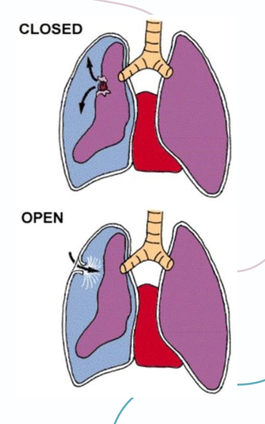 <p>1- Spontaneous (closed)</p><p>a. Primary</p><p>b.secondary</p><p></p><p>2- Traumatic (open)</p><p>a. Penetrating trauma</p><p>b. Blunt trauma</p>
