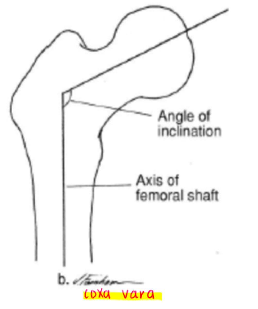 <p>decreased angle of inclination</p><p>*less than 110 degrees</p>