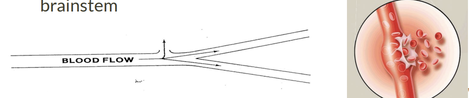 <p><span data-name="black_small_square" data-type="emoji">▪</span> Caused by rupture or leakage of cerebral blood vessels. </p><p><span data-name="black_small_square" data-type="emoji">▪</span> May be the result of weakness of a vessel wall or extreme fluctuations in blood pressure </p><p>1. Extracerebral hemorrhages-hemorrhages from blood vessels in the meninges or on the surface of the brain (bleeding outside brain). </p><p>2. Intracerebral hemorrhages-hemorrhages within brain or brainstem</p>