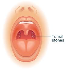 <p>food gets calcified</p><p>halitosis</p>