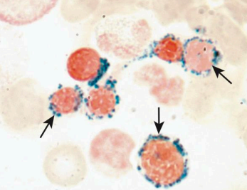 <ul><li><p>iron not incorporated into heme</p></li><li><p>ringed sideroblasts</p></li><li><p>iron in bone marrow </p></li><li><p>treated with vitamin b6</p></li></ul><p></p>