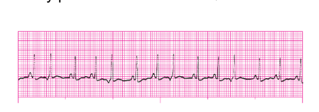 <p>What is the Rhythm for PJCs</p>